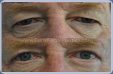 Eyelid Surgery