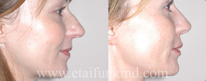 rhinoplasty houston