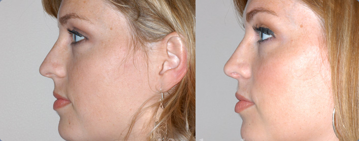 houston plastic surgery for nose