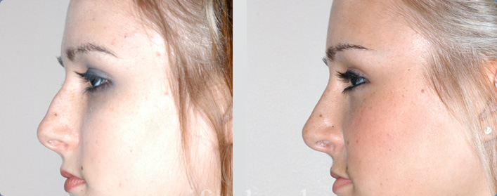 cost for rhinoplasty in houston tx