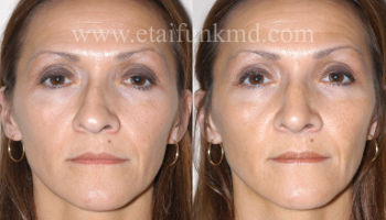 revision rhinoplasty houston tx