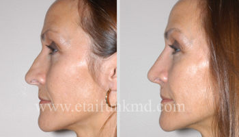 cost of revision rhinoplasty in houston tx