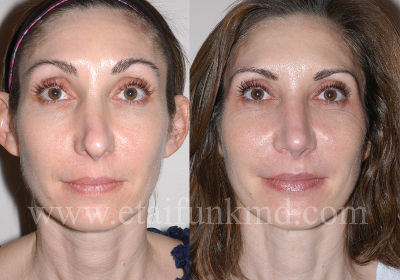 Revision rhinoplasty surgeon houston tx