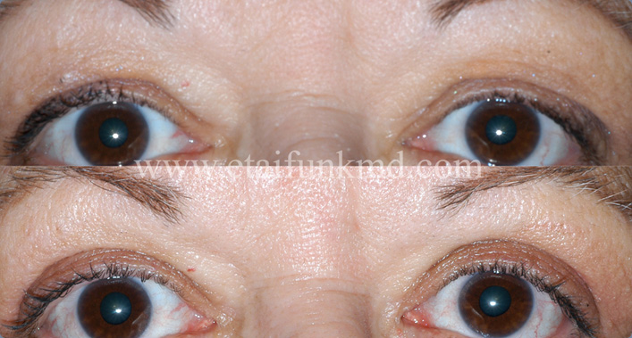 Blepharoplasty surgeon houston