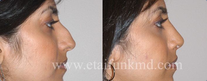 rhinoplasty houston