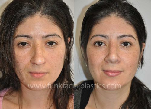 houston rhinoplasty surgeon