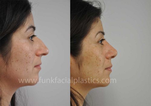 rhinoplasty houston