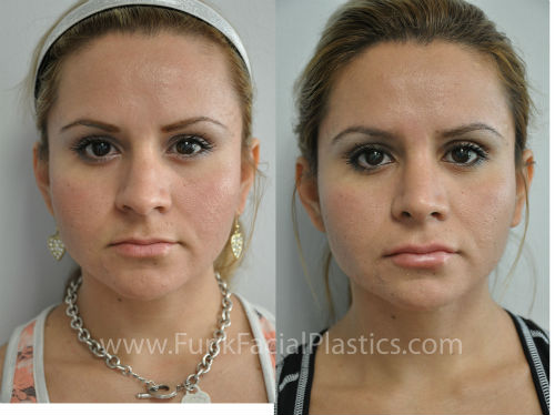 houston rhinoplasty & nose jobs