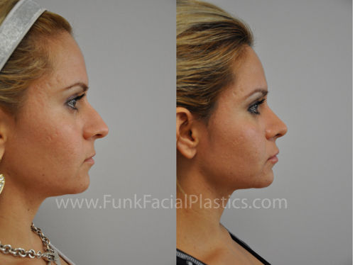 rhinoplasty houston, tx