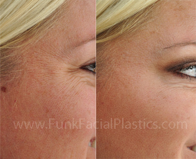 Wrinkle treatment Houston