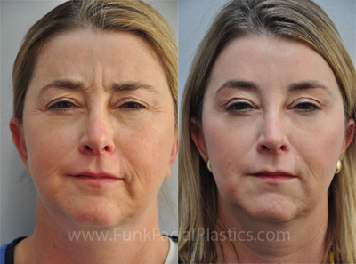 Houston Facial Plastic Surgeon