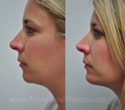 Chin Implant Surgery Houston