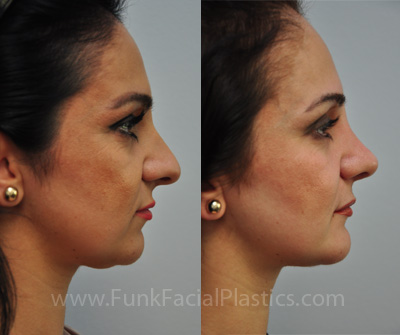 Chin implant Houston