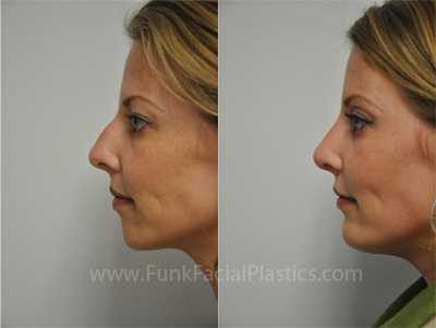 Chin implant Houston