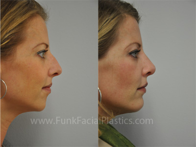 Chin augmentation Houston