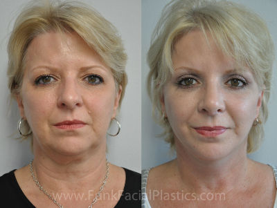 Facelift and Nose Job Houston