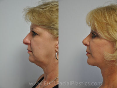 houston facelift surgery