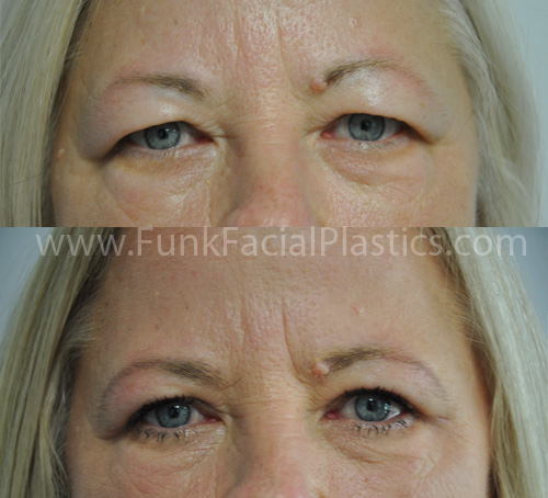 Upper Blepharoplasty Houston