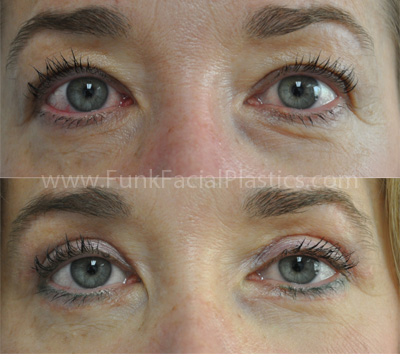 Eyelid surgery Houston