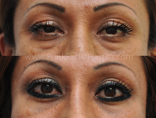 Lower Eyelid Surgery Houston