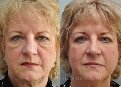 Eyelid surgery Houston