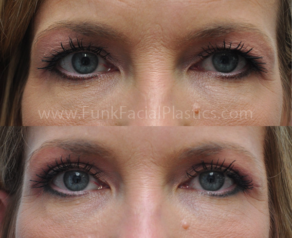 Top eyelid surgeon Houston