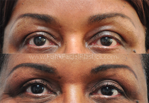 Ethnic Upper Eyelid Surgery Houston