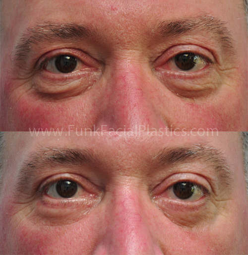 Male Lower Eyelid Surgery Houston