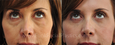 upper and lower blepharoplasty