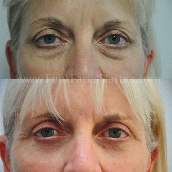 Eyelid Surgery Houston