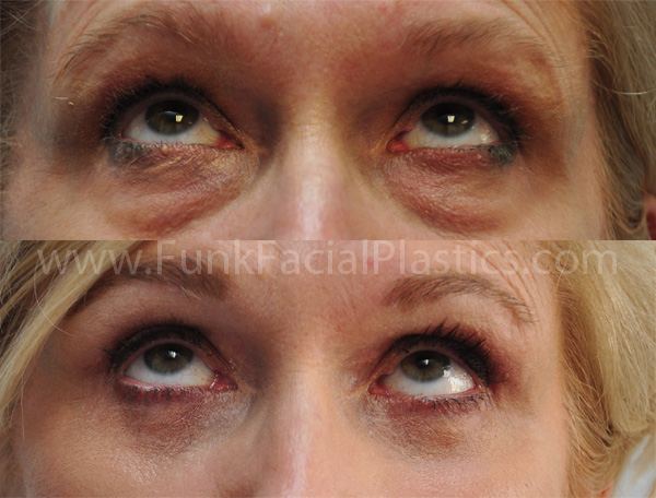 Lower Eyelid Surgery Houston