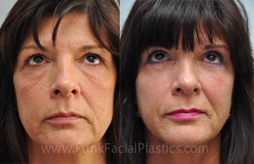 Lower Blepharoplasty Houston