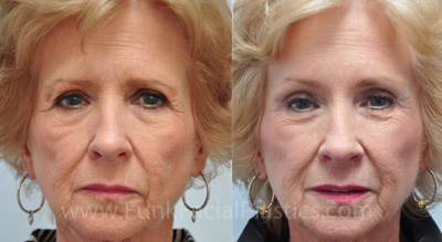 Endoscopic Browlift with Upper Eyelid Surgery Houston