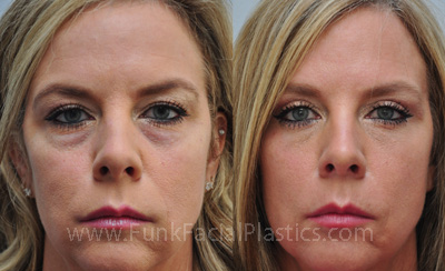 Lower Eyelid Fat Repositioning in Houston