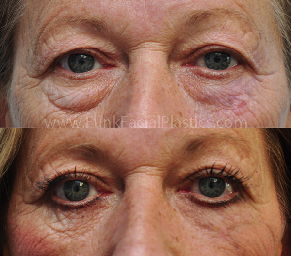 Lower eyelid surgery Houston