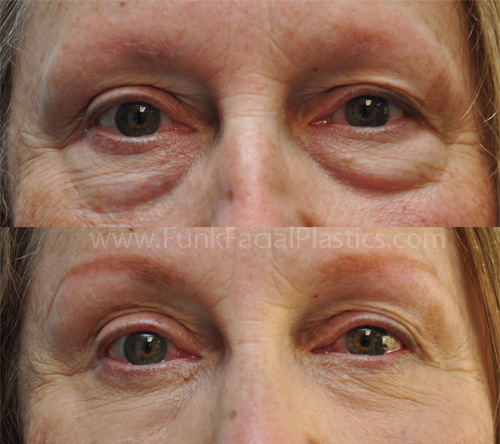 Lower eyelid lift 