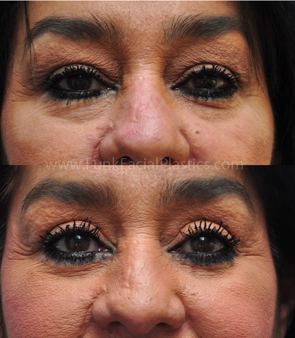 Eyelid Lift Houston