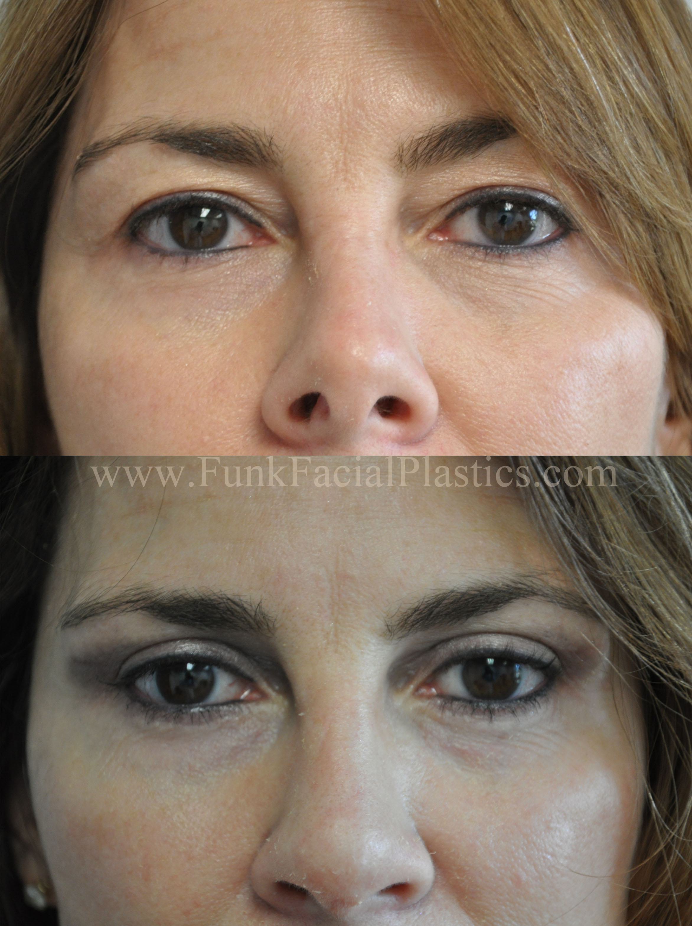 Eyelid Lift Houston