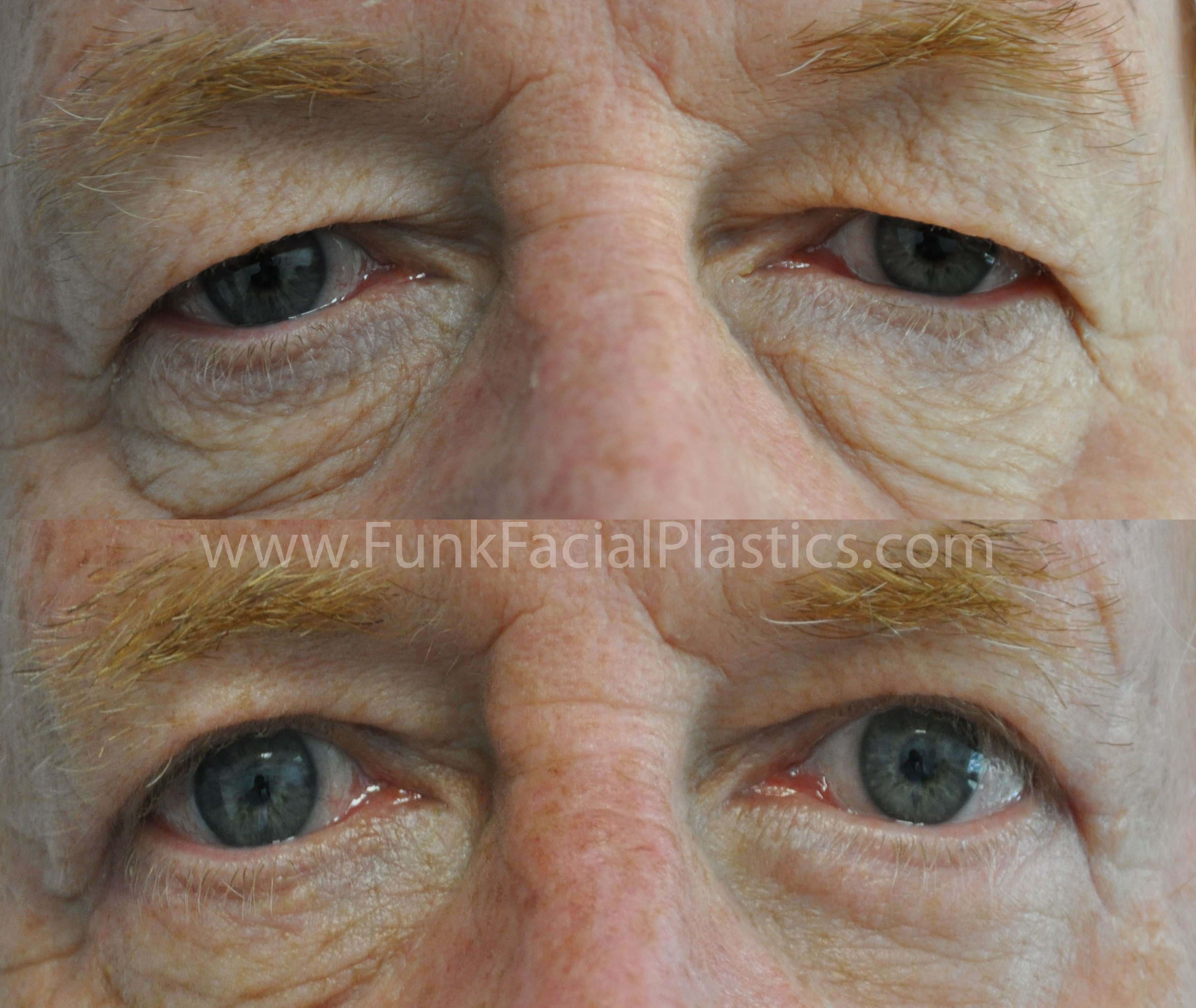 Male eyelid surgery