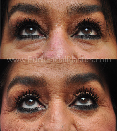 Best eyelid plastic surgeon Houston