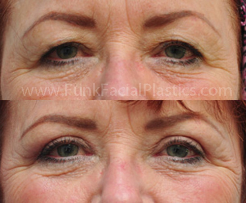 Upper Eyelid Surgery Houston