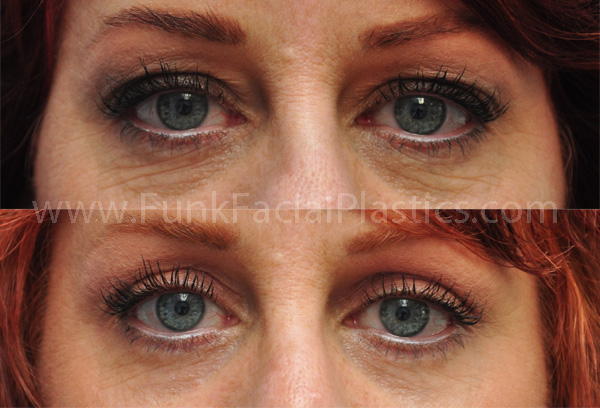 Best Eyelid Surgeon Houston