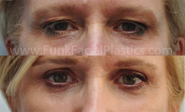 Eyelid Surgery Houston, TX