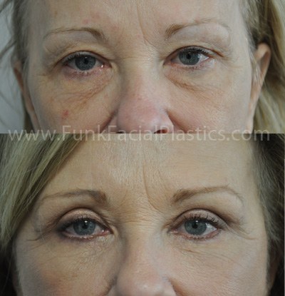 Eyelid lift