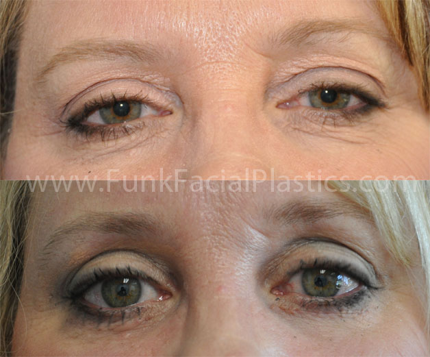 Blepharoplasty patient