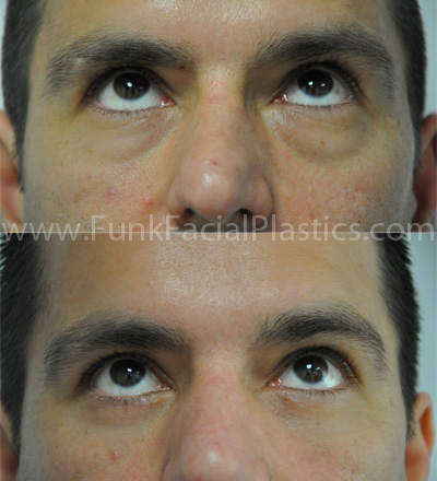 Male eyelid surgery