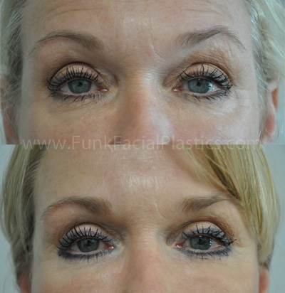 Eyelid Surgery Houston