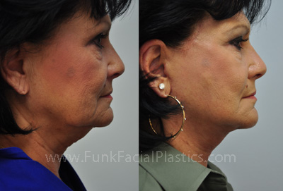 Neck lift in Houston