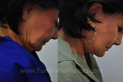 Top Facelift Surgeon in Houston