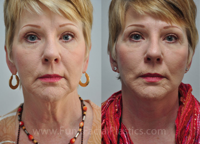 Top Facelift Surgeon Houston